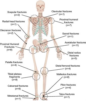 Progress of fracture mapping technology based on CT three-dimensional reconstruction